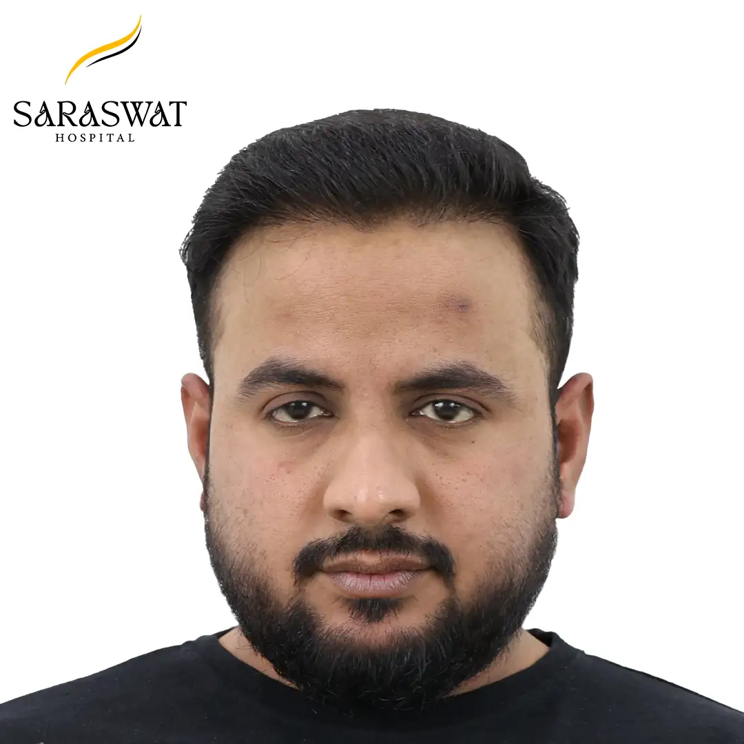 Hair Transplant After Result