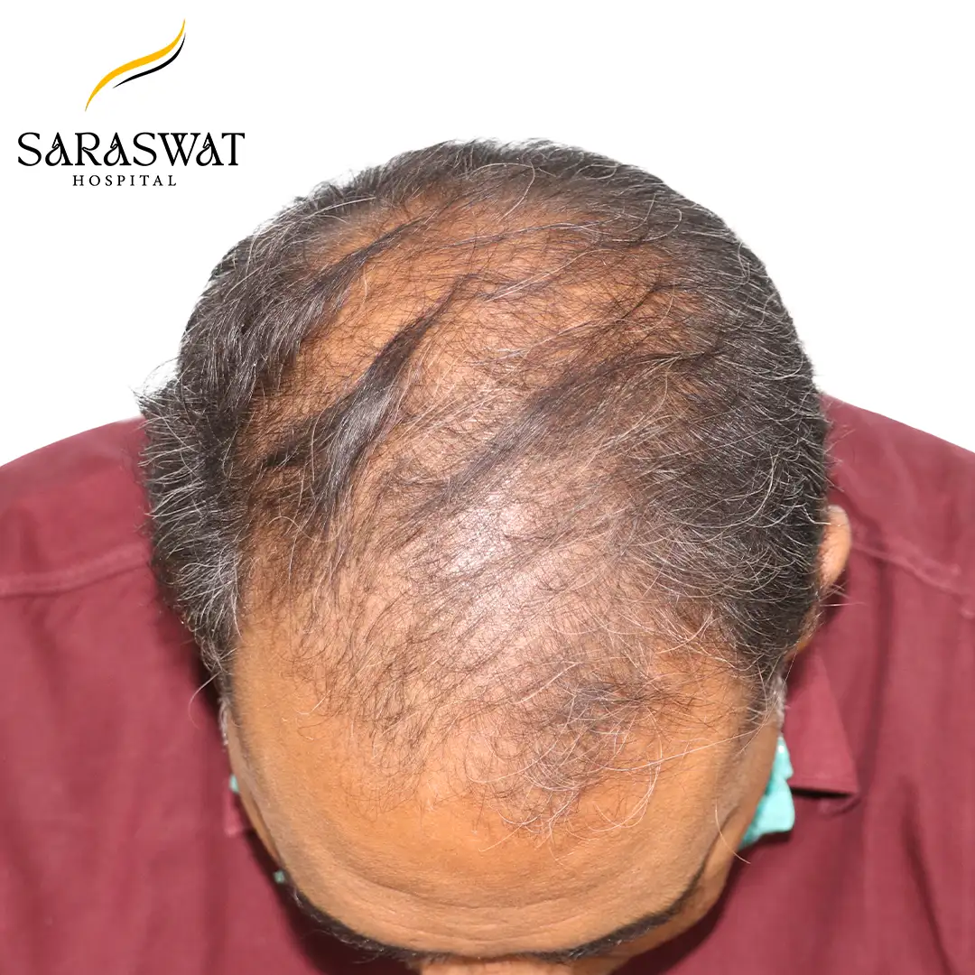 Hair Transplant Before Results