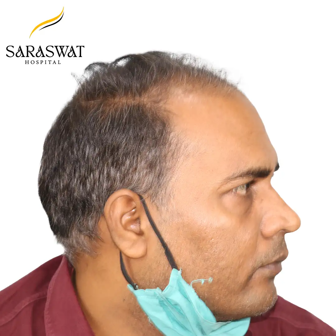 Hair Transplant Before Results