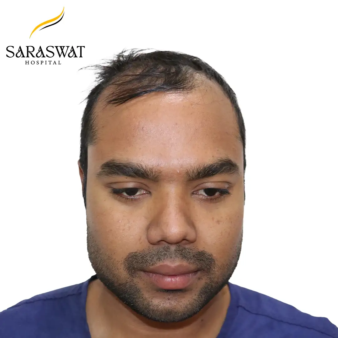 Front FUE Hair Transplant Result Before Procedure