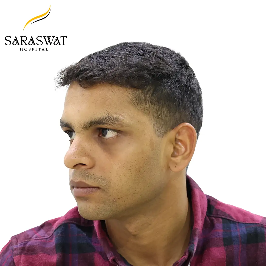 Hair Transplant Before After