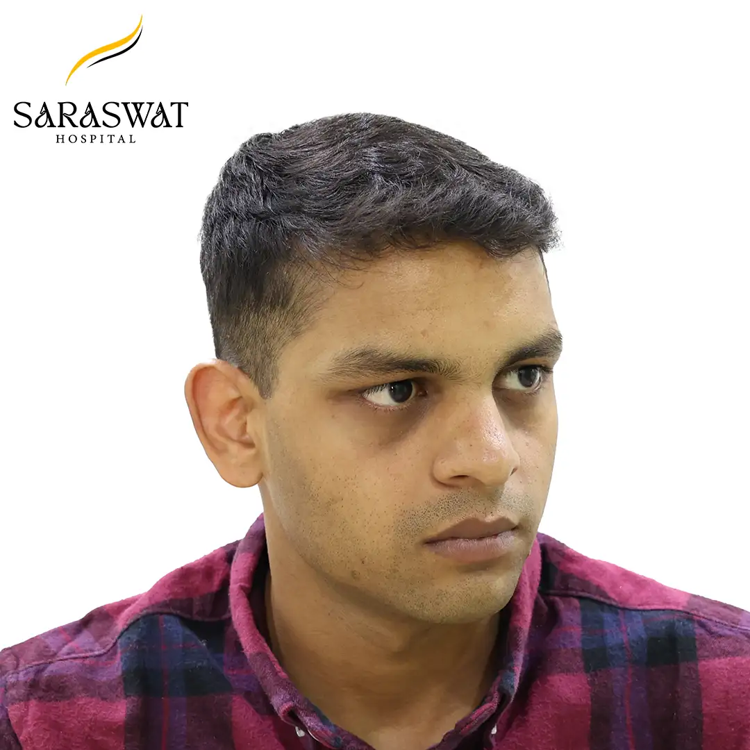 Hair Transplant Before After