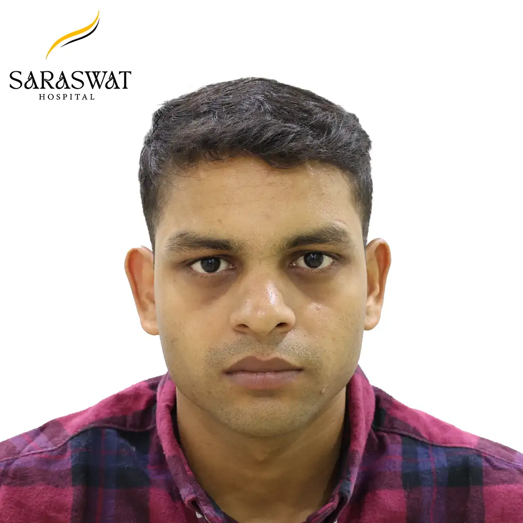 Hair Transplant Before After