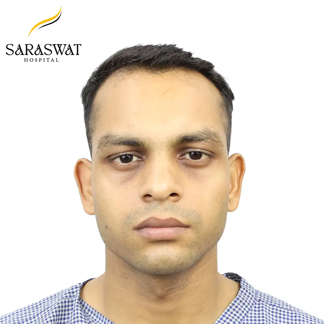 Hair Transplant Before After