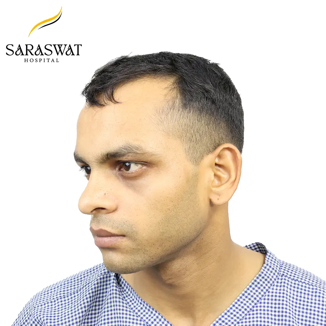 Hair Transplant Before After
