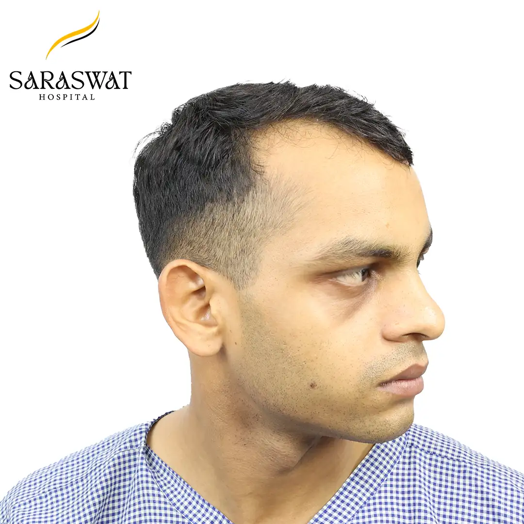 Hair Transplant Before After
