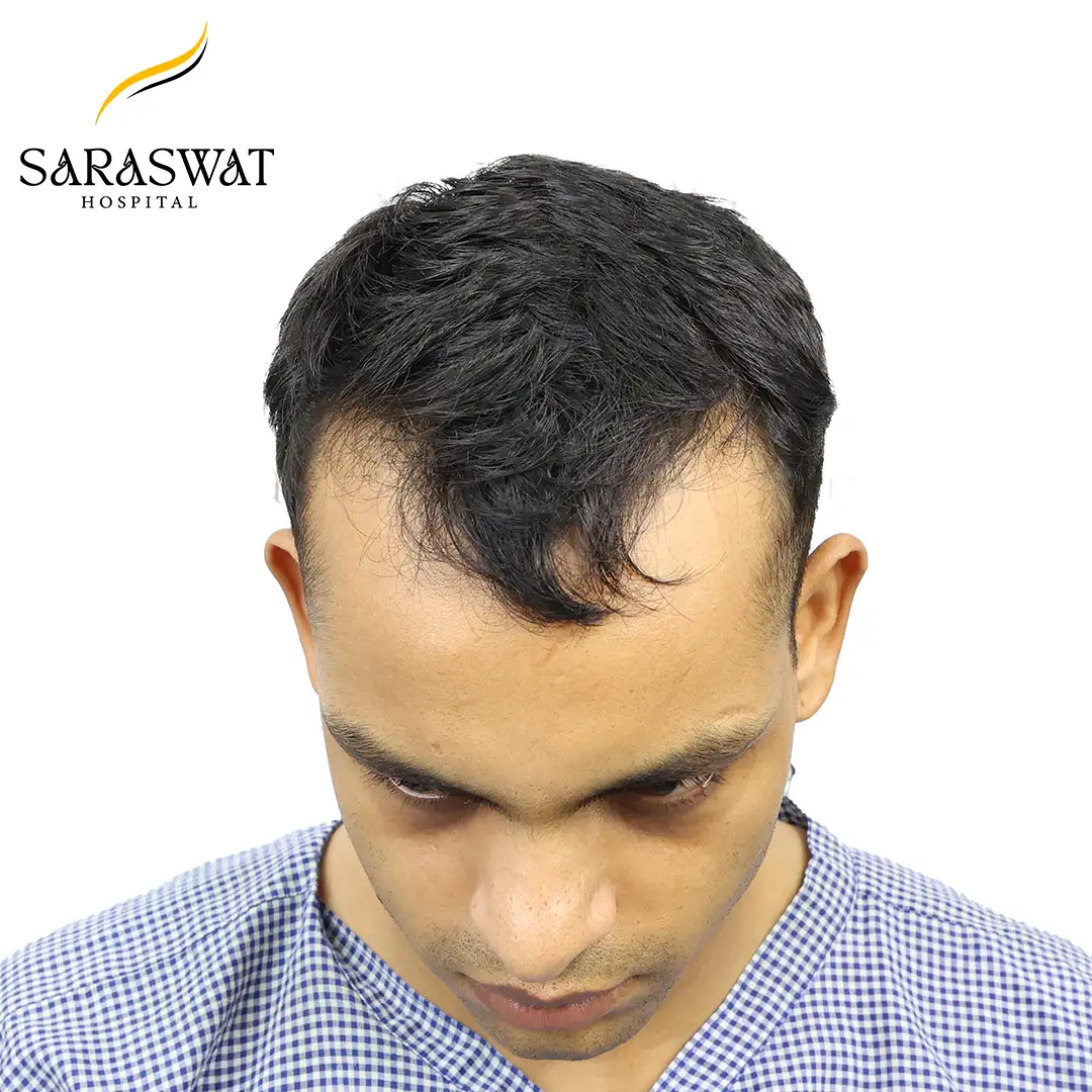 Hair Transplant Before After