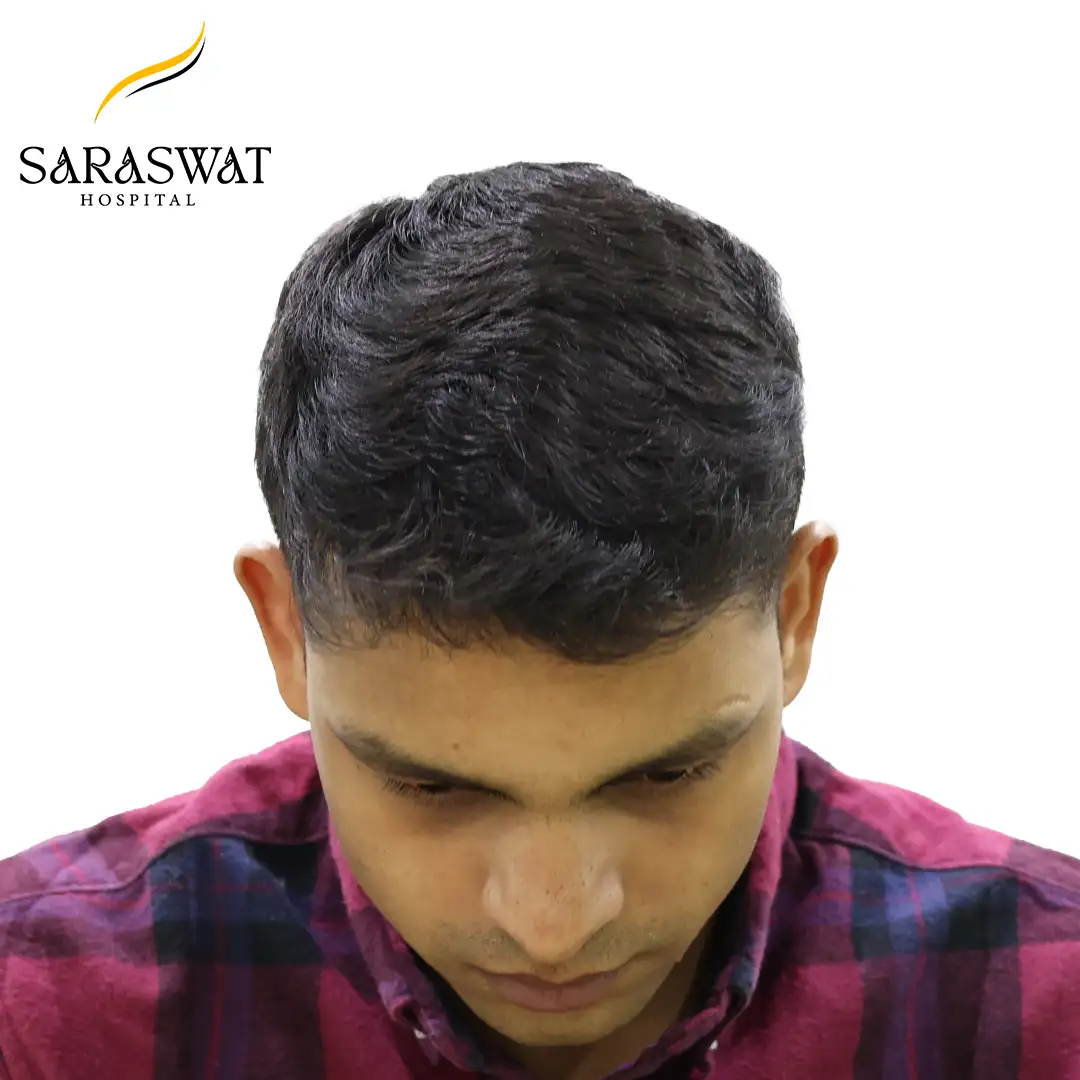 Hair Transplant Before After