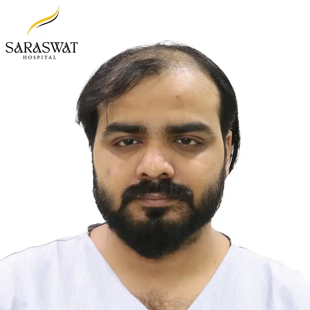 Front FUE Hair Transplant Result Before Procedure