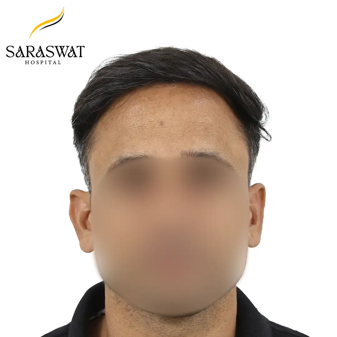 Front FUE Hair Transplant Before After