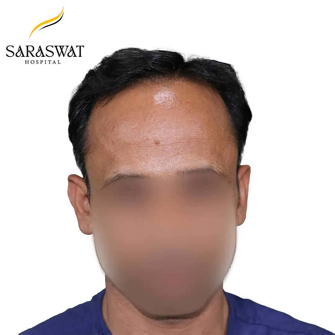 Front FUE Hair Transplant Before After