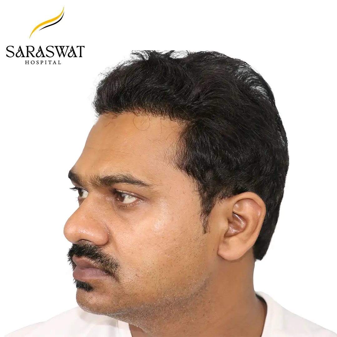 FUE Hair Transplant