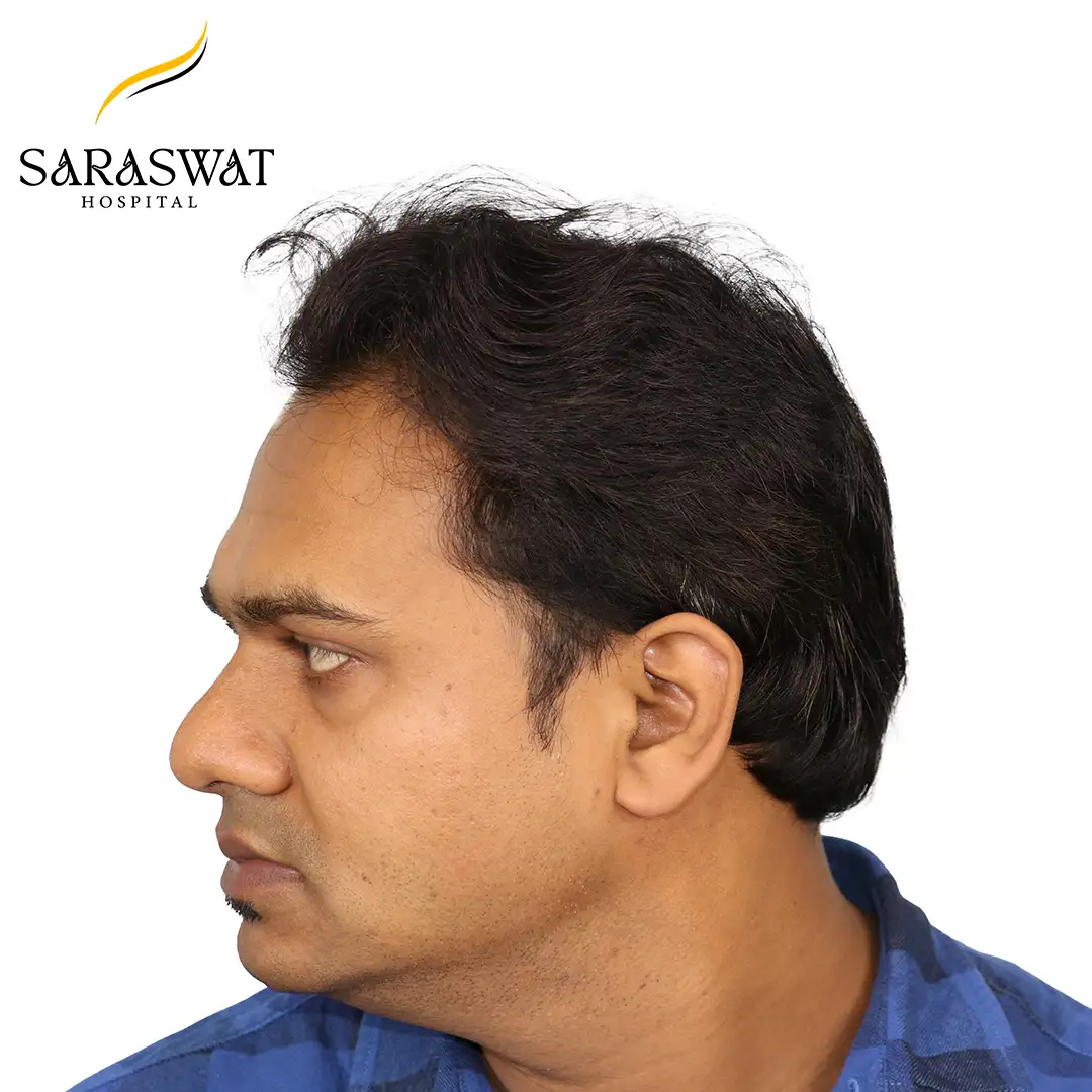 FUE Hair Transplant