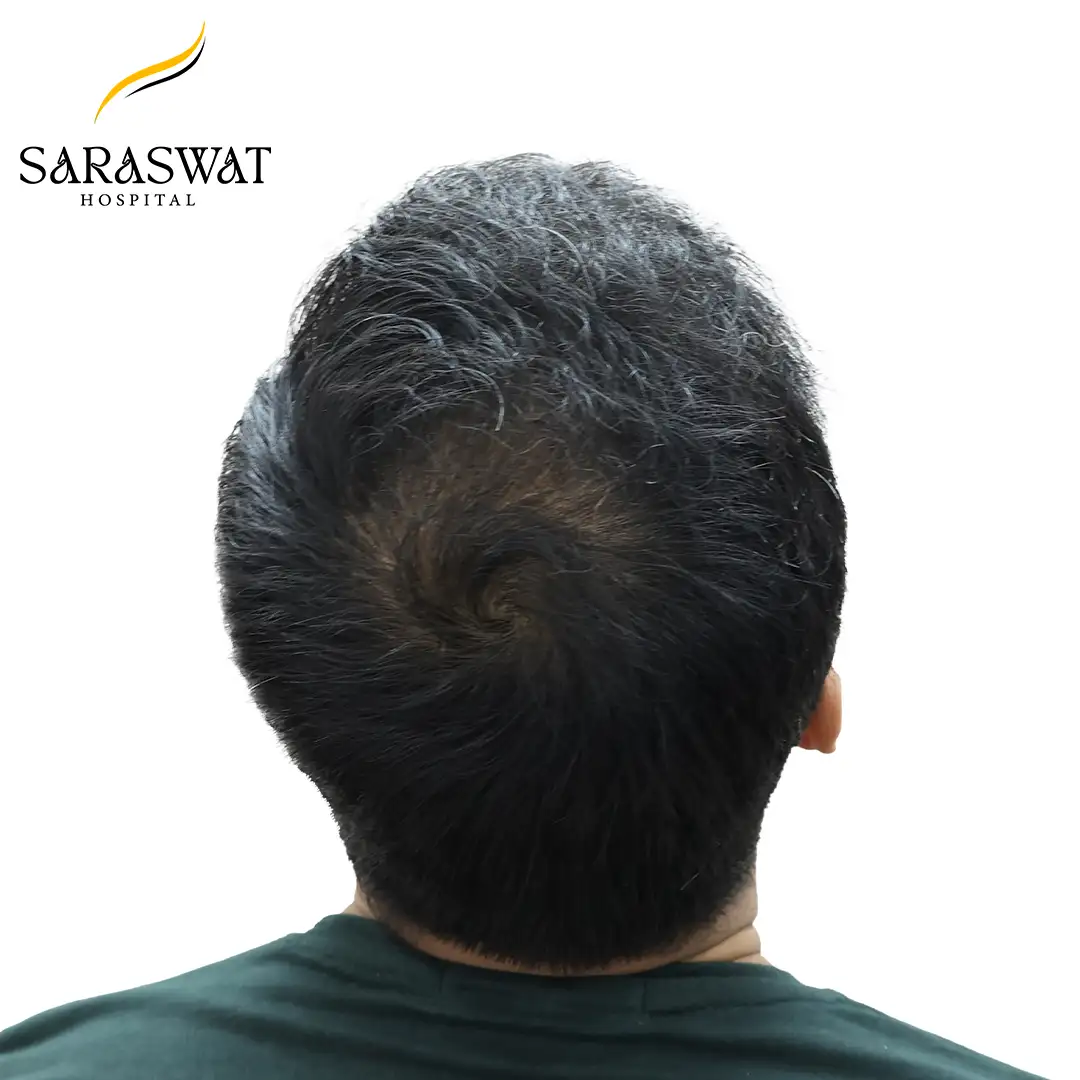 Hair Transplant Before and After