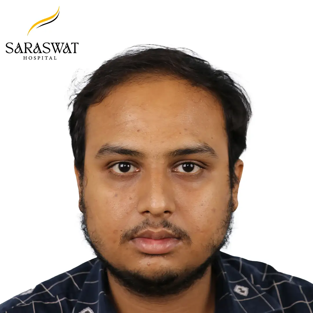 Front FUE Hair Transplant Result Before Procedure