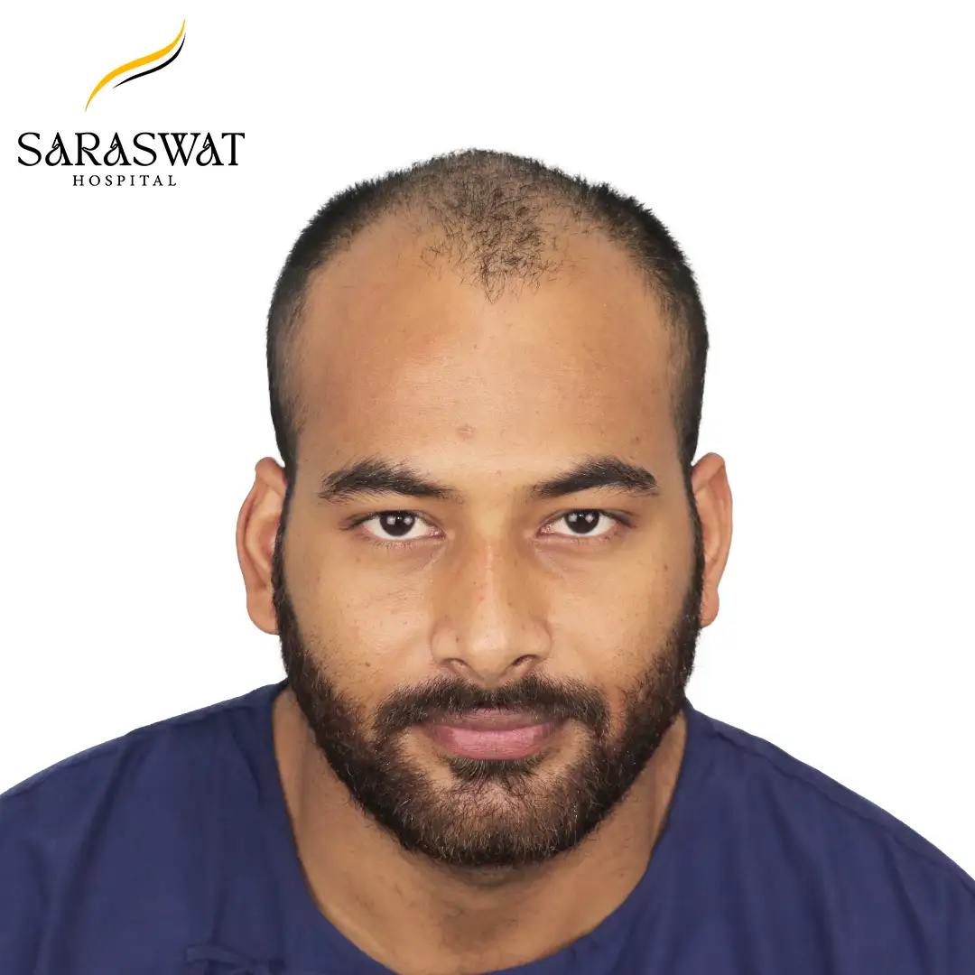 Front FUE Hair Transplant Result Before Procedure