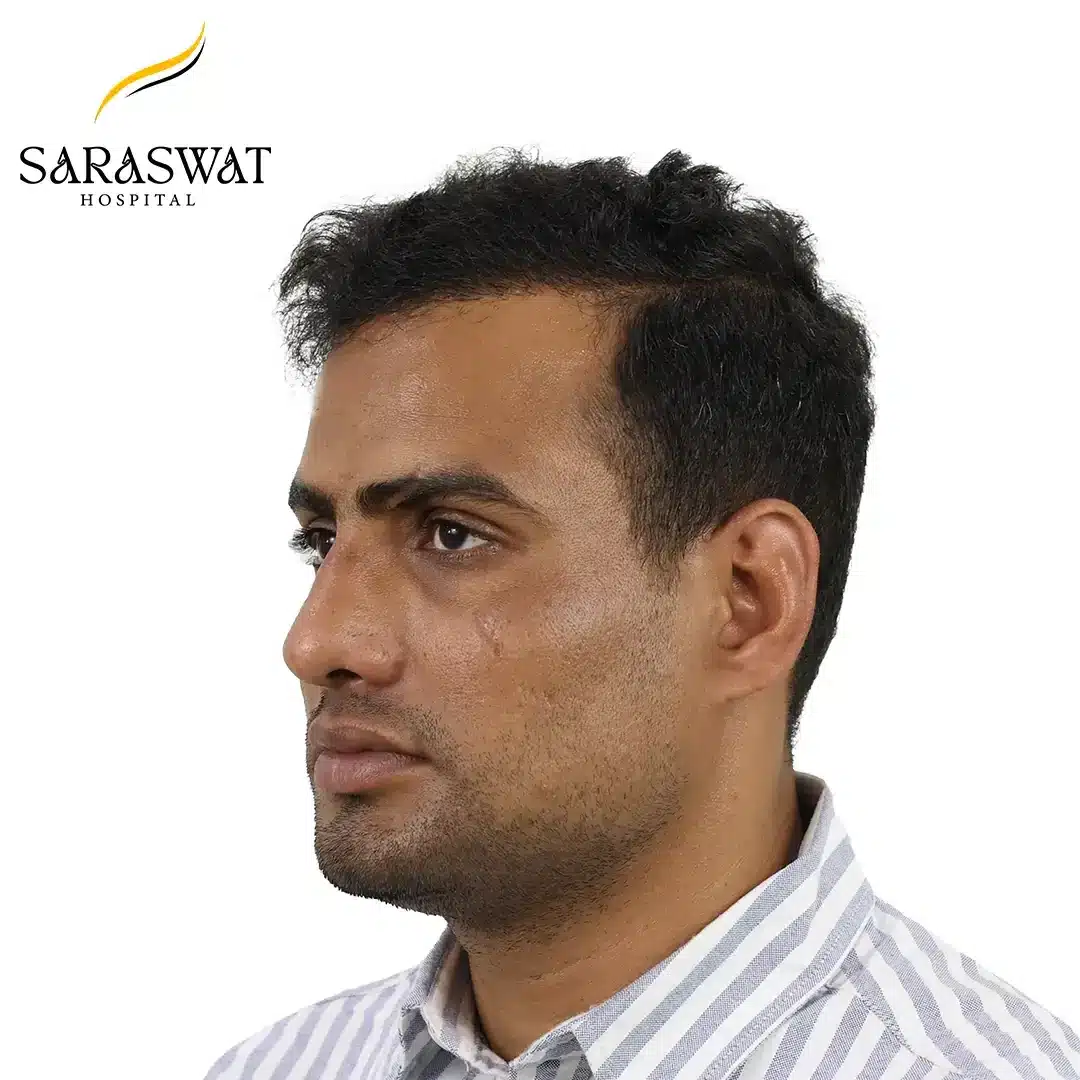 Hair Transplant Before and After