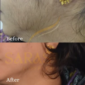 Facial Hair Removal
