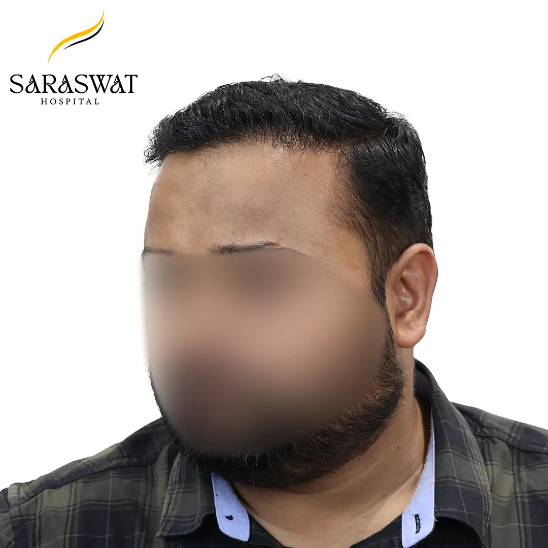 Hair Transplant Before and After
