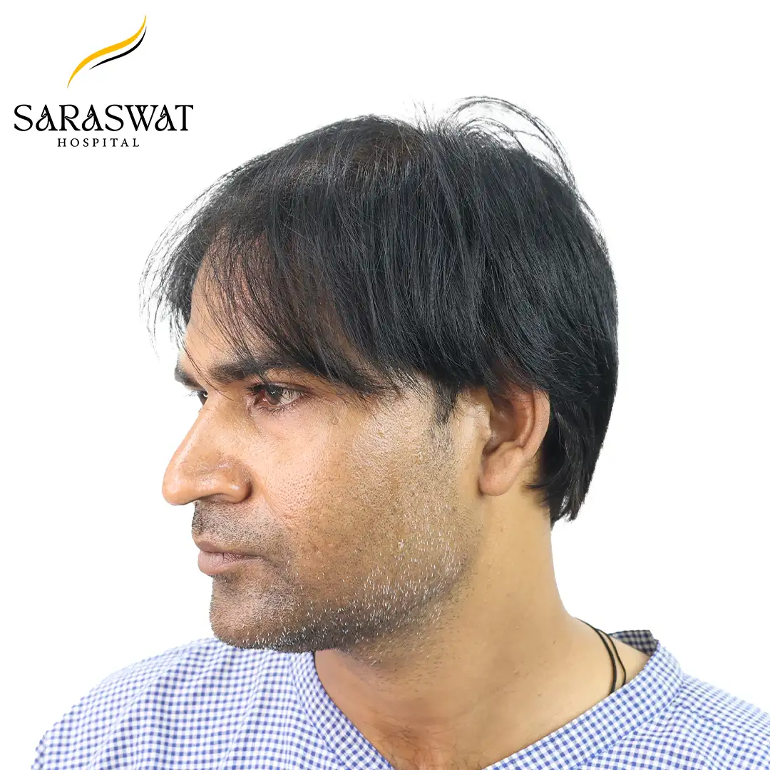 Hair Transplant Before and After Results