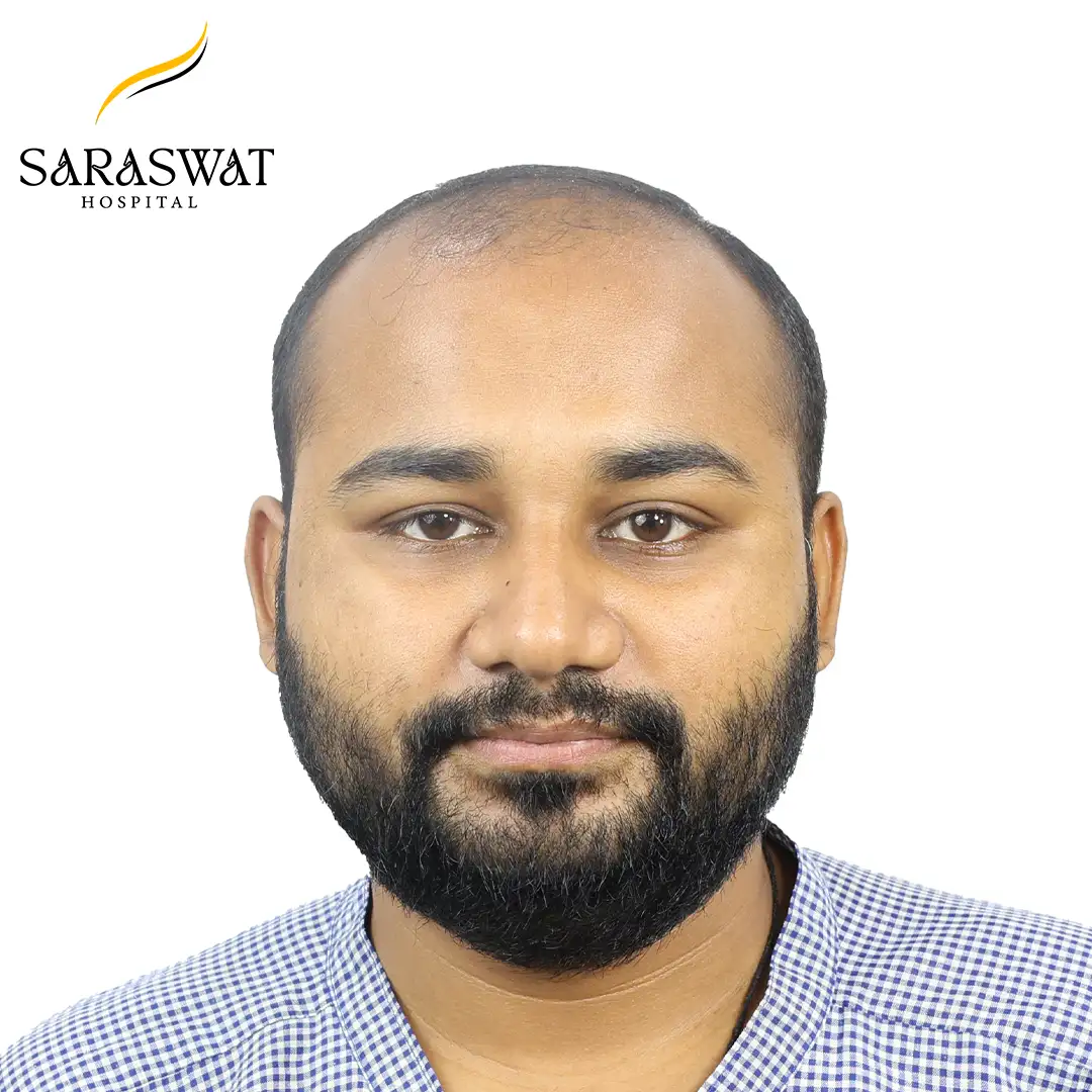 Front FUE Hair Transplant Result Before Procedure