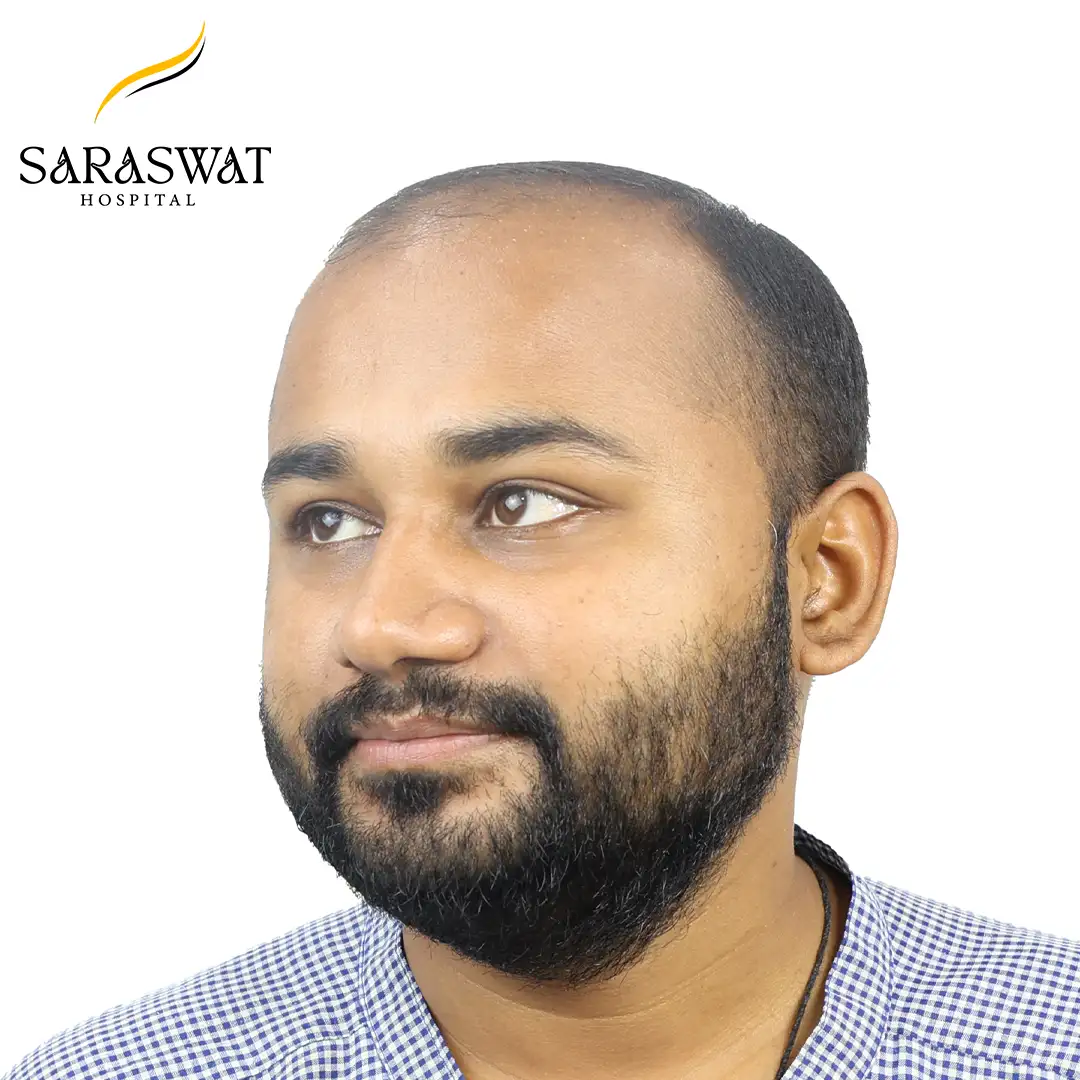 FUE Hair Transplant