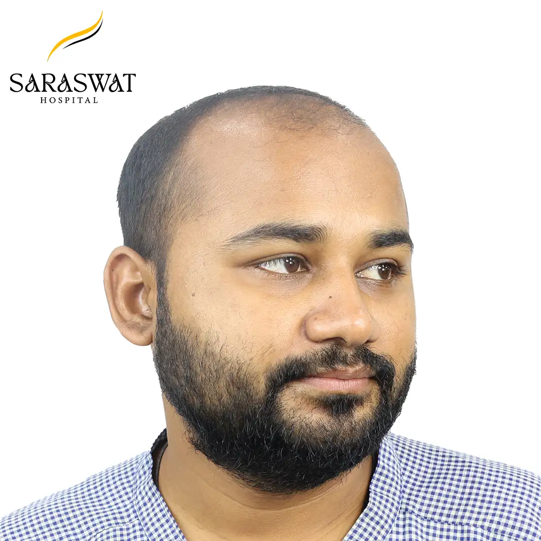 FUE Hair Transplant