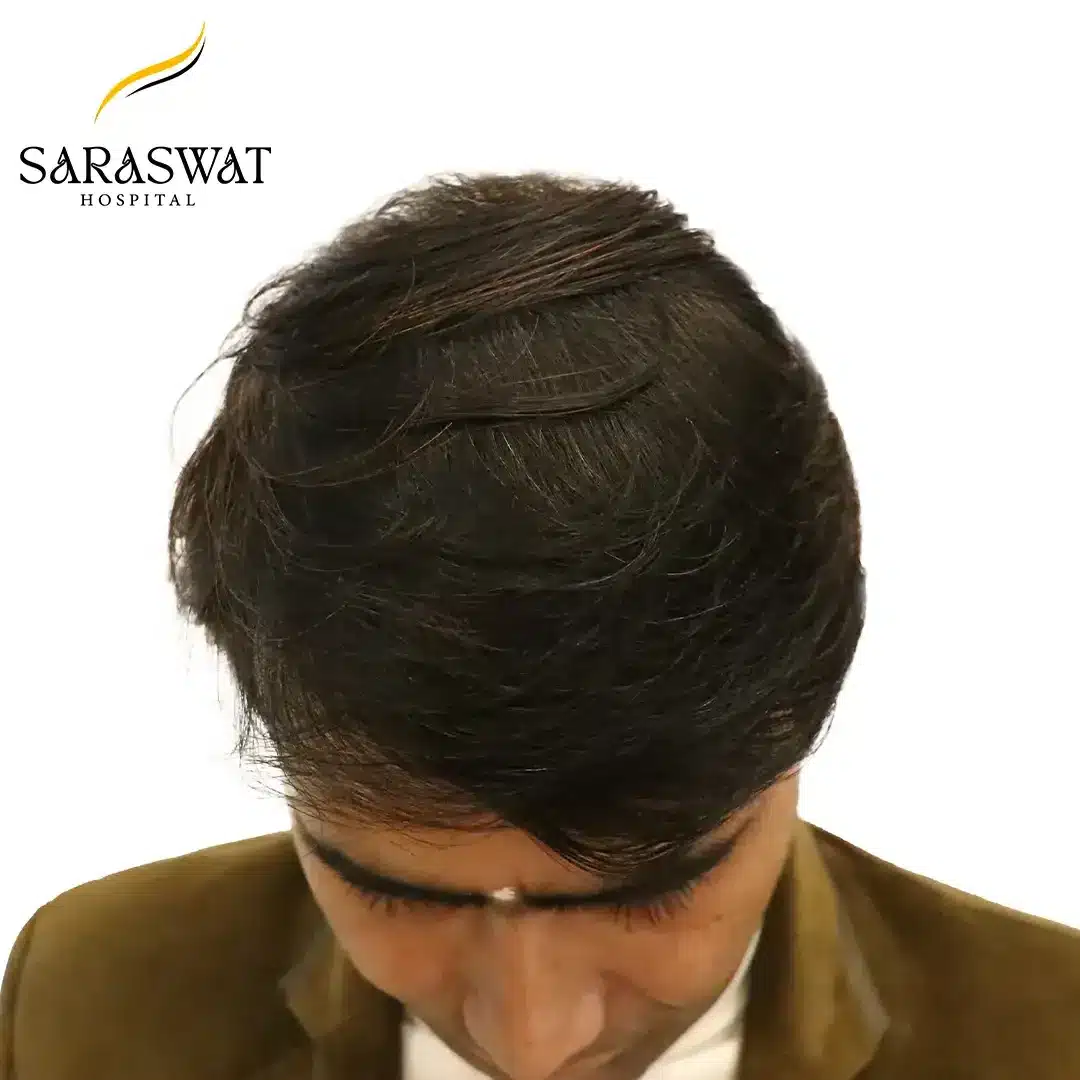 Top FUE Hair Transplant Result After Procedure