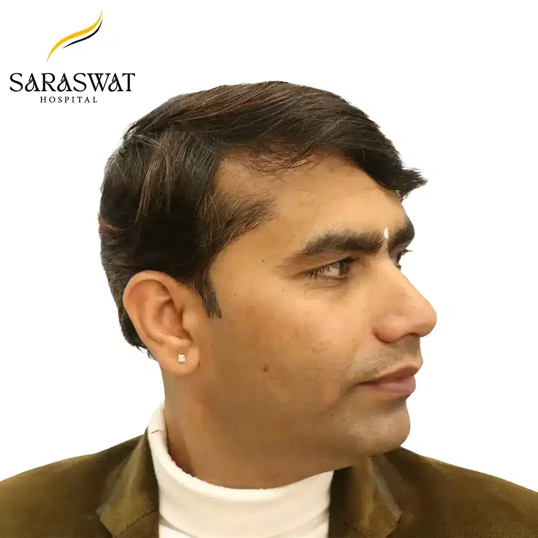 90 Degree Right FUE Hair Transplant Result After Procedure