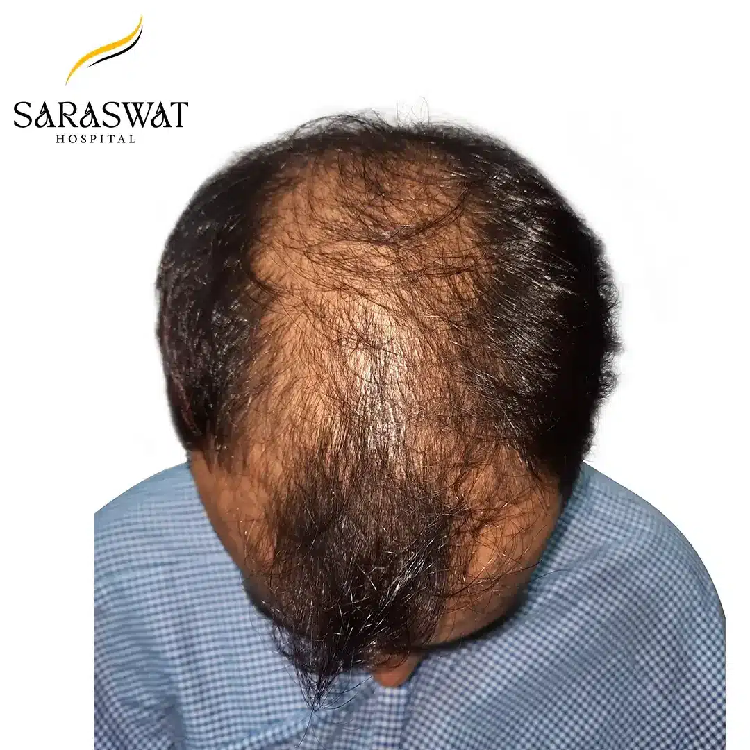 Top FUE Hair Transplant Result Before Procedure