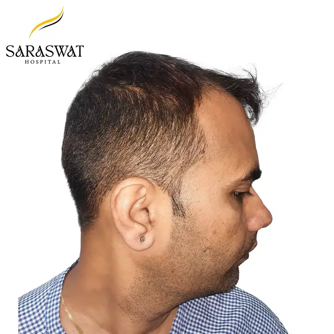 90 Degree Right FUE Hair Transplant Result Before Procedure90 Degree Right FUE Hair Transplant Result Before Procedure