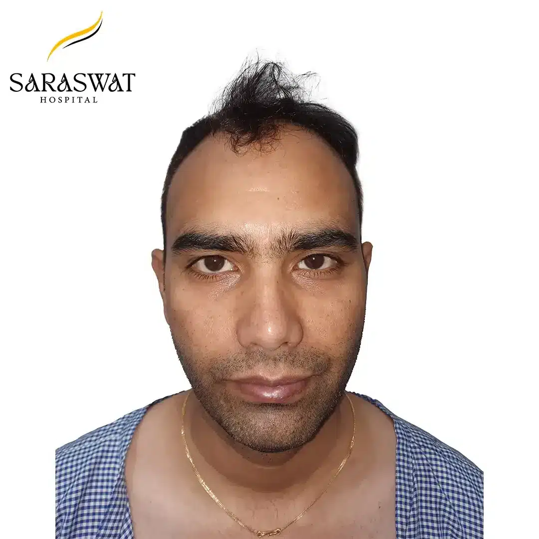 Front FUE Hair Transplant Result Before Procedure