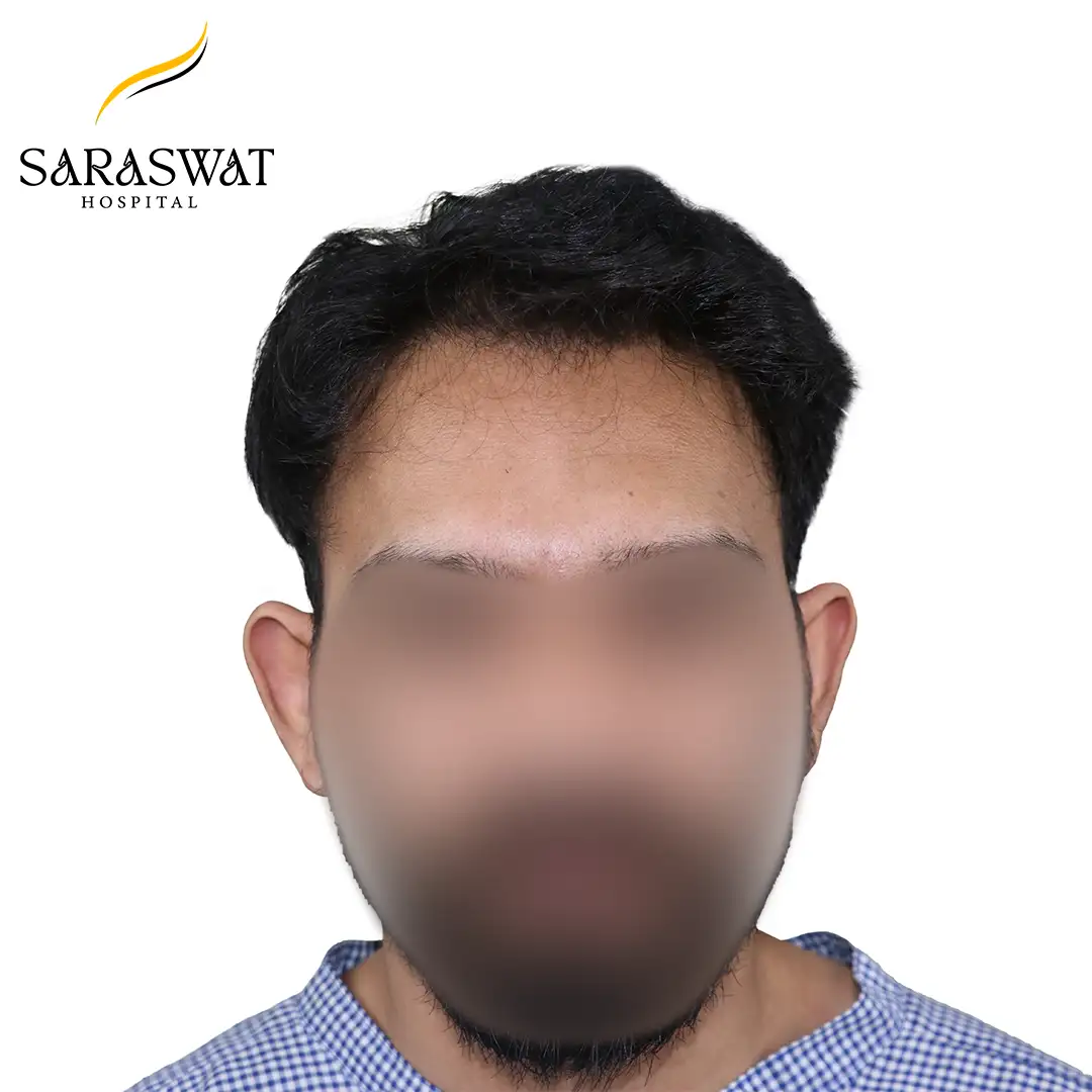 Front FUE Hair Transplant Result Before Procedure