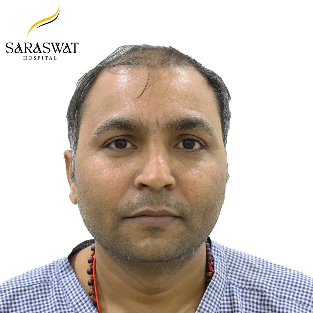 Front FUE Hair Transplant Result Before Procedure