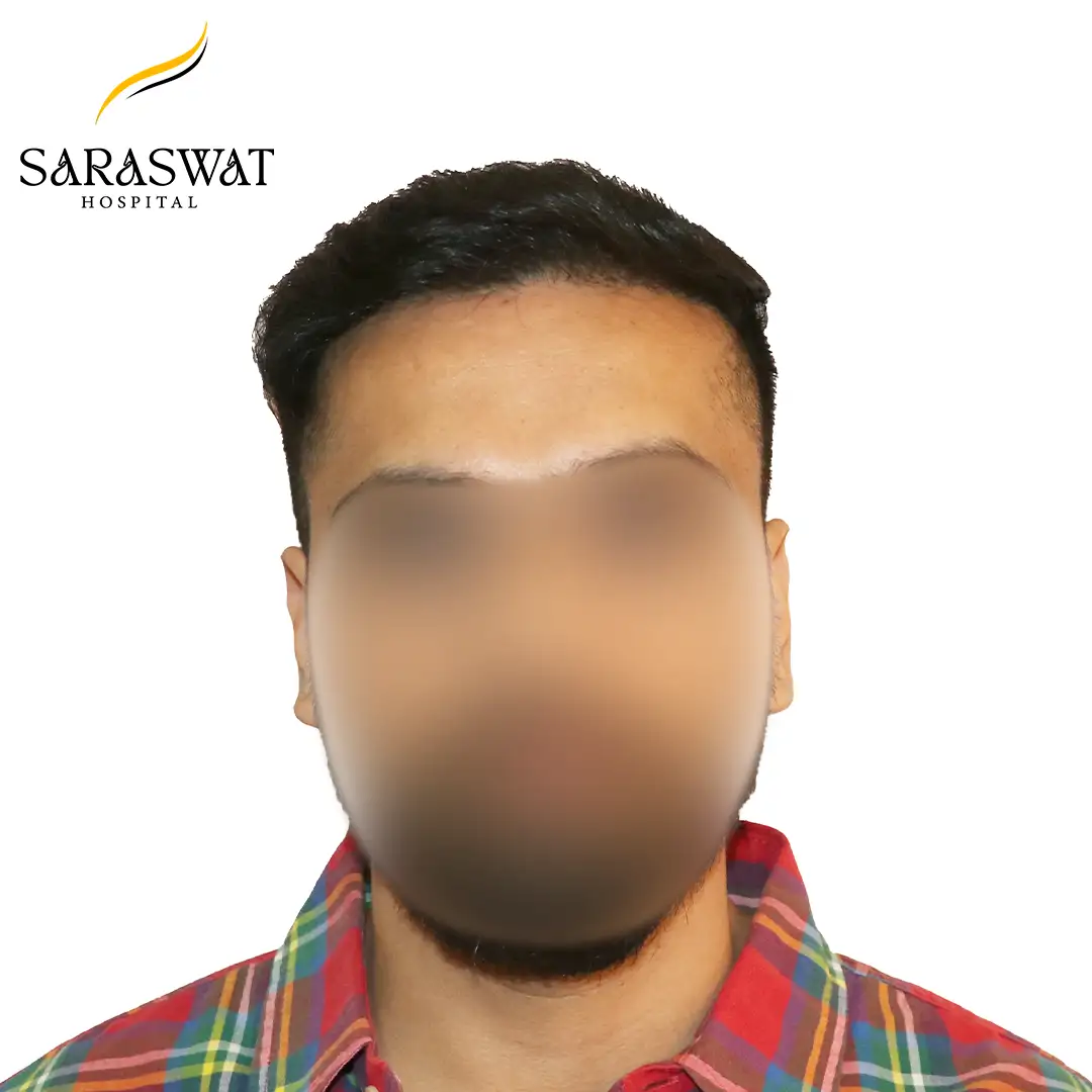 FUE Hair Transplant