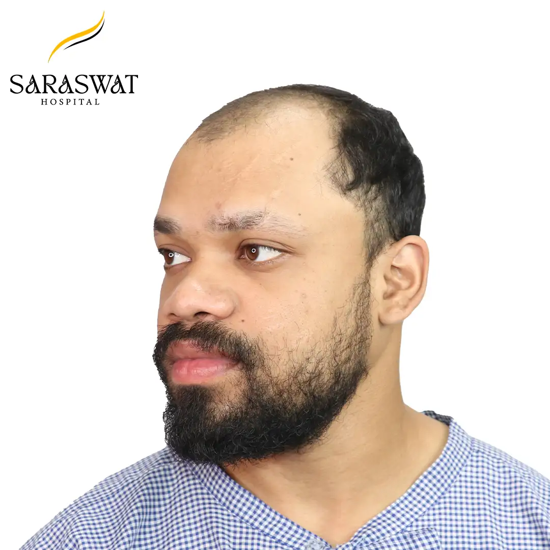 45 Degree Left FUE Hair Transplant Result Before Procedure