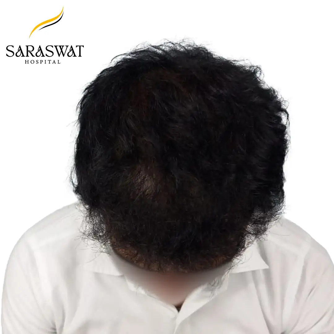 FUE Hair Transplant