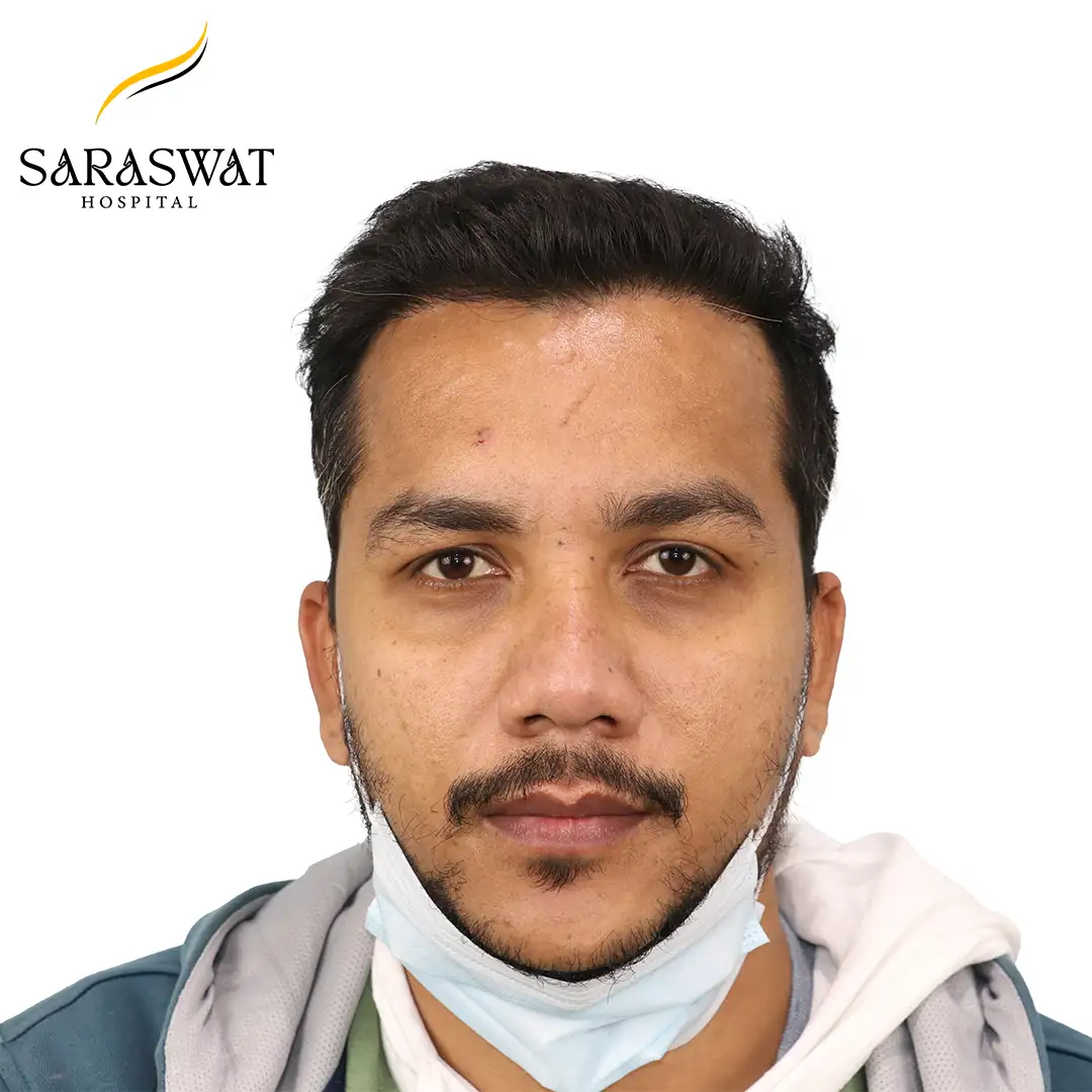 FUE Hair Transplant