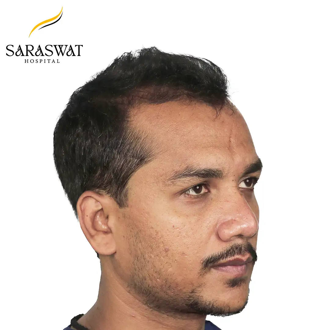 Hair Transplant Before and After Results