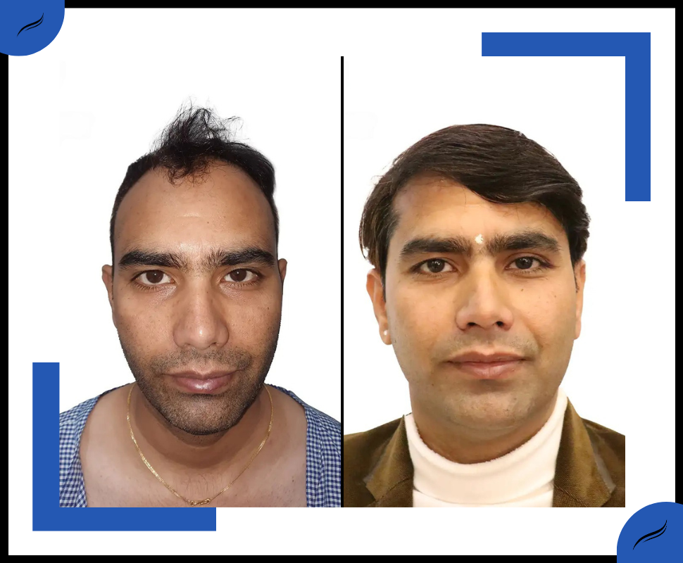 Hair Transplant Before and After