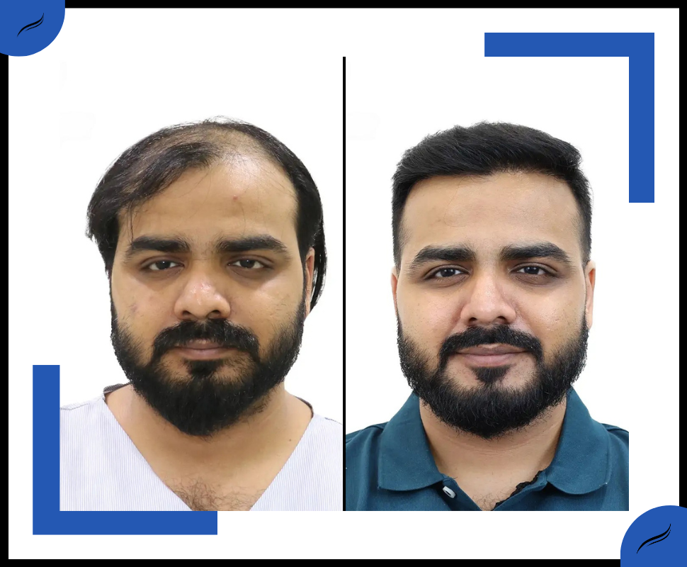 Best Hair Transplant in India