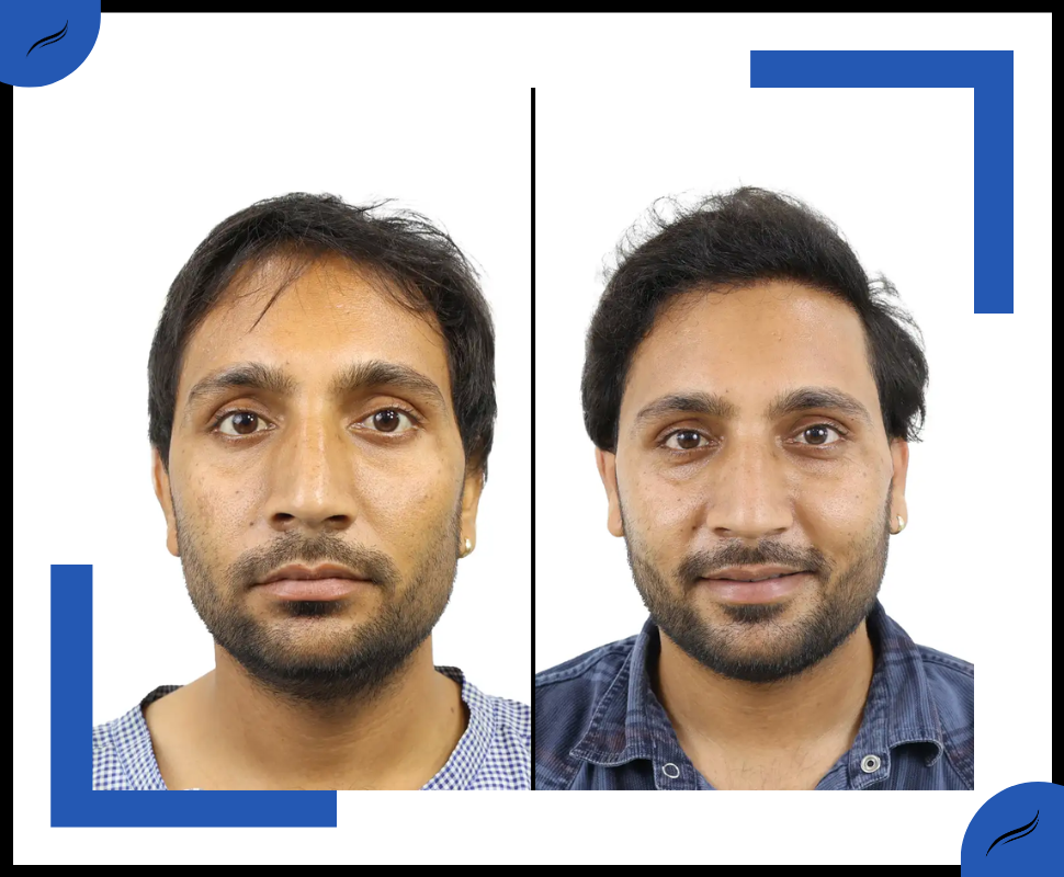 Hair Transplant Before and After | Hair Transplant Result