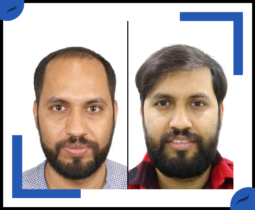 Best Hair Transplant in India
