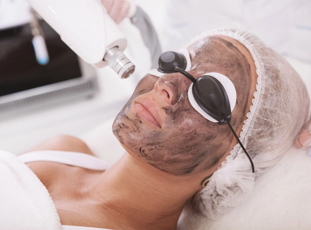 Carbon Peel Laser Facial in India | Treatment for Acne & Pores