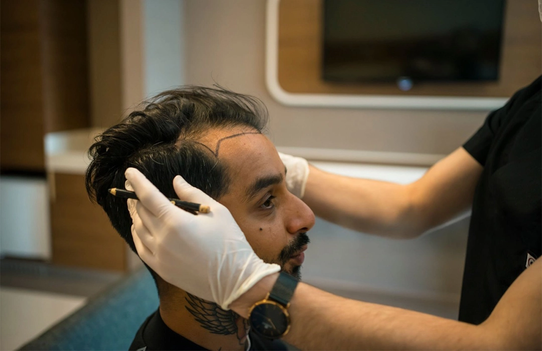 Cost of a FUE Hair Transplant in India