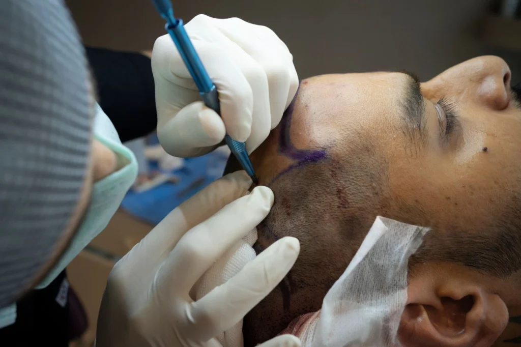Hair Wash After Hair Transplant
