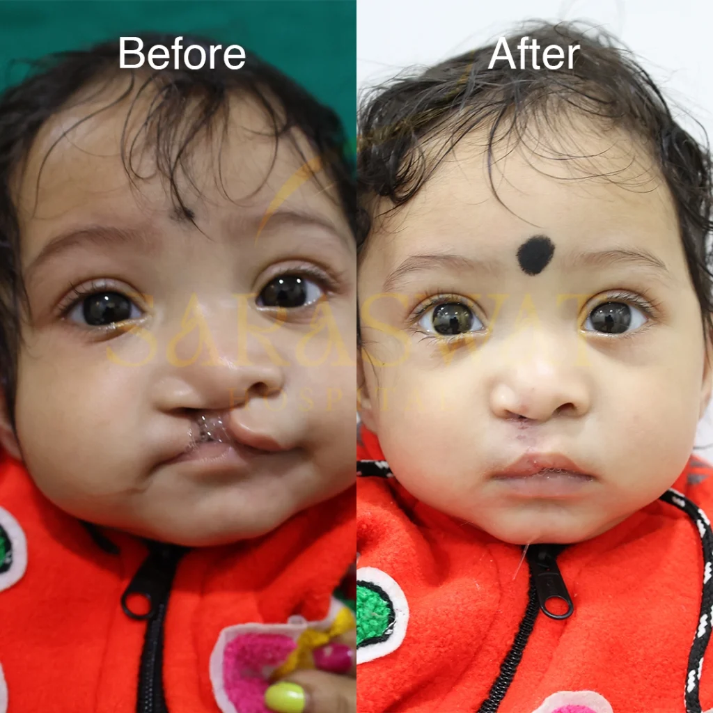 Best Cleft Lip and Palate Surgeon in India
