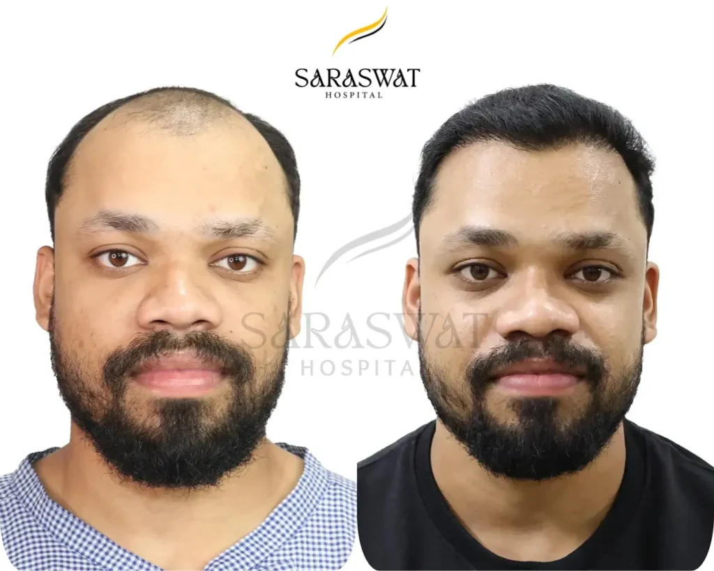 How Do I Get The Best Hair Transplant Result? - Key Takeaways