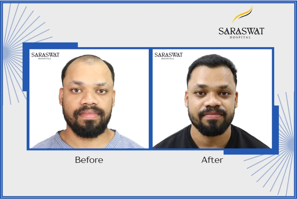 How Do I Get The Best Hair Transplant Result? - Key Takeaways