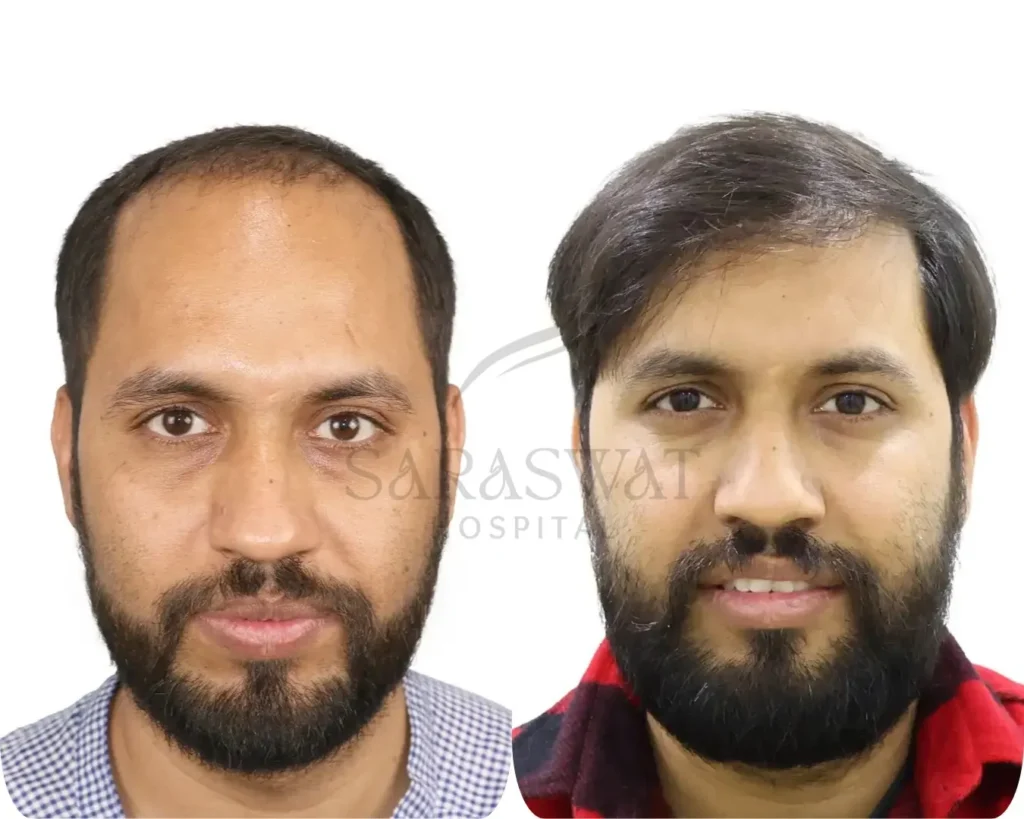 Top Hair Transplant Clinics in India